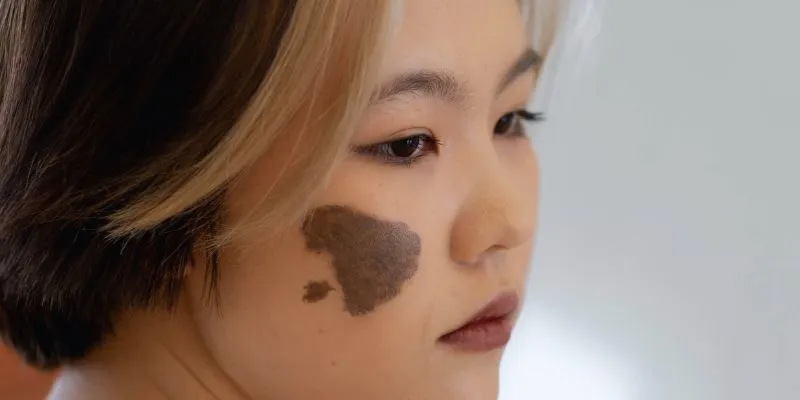 Different types of birthmarks
