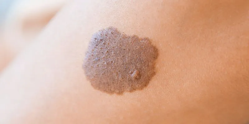 Common causes of birthmarks