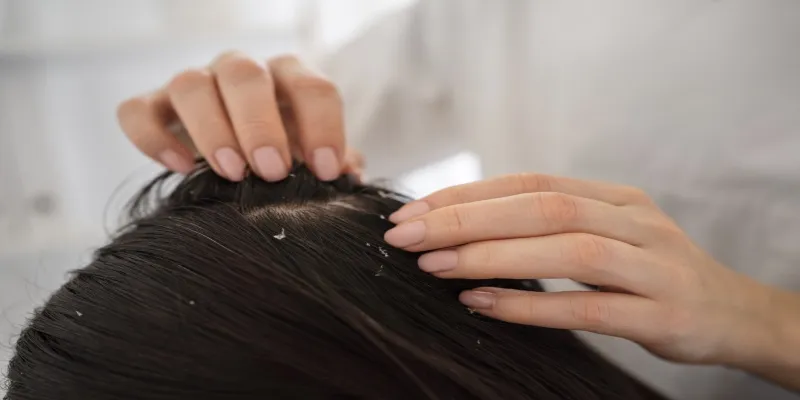 Comparing flake appearance between dry scalp and
dandruff