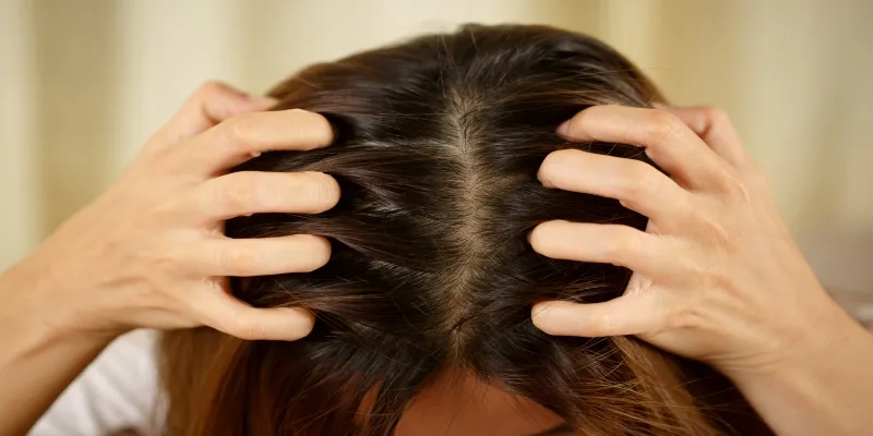 Itch intensity comparison between dry scalp and
dandruff