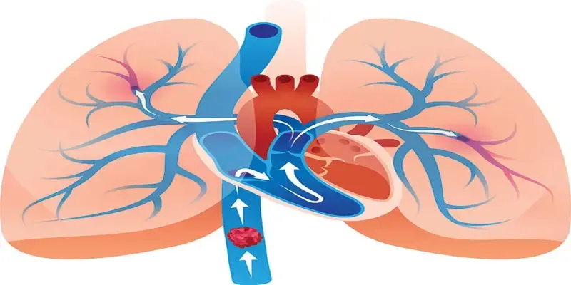 Illustration of a Pulmonary
Embolism