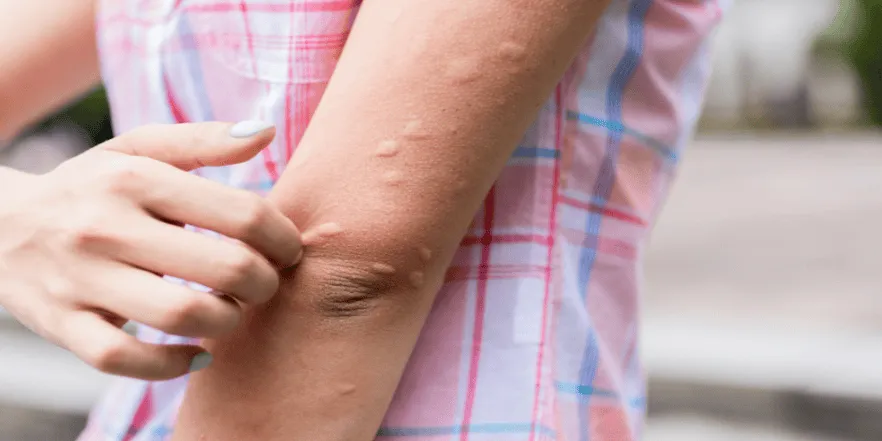 Chronic Hives
Illustration