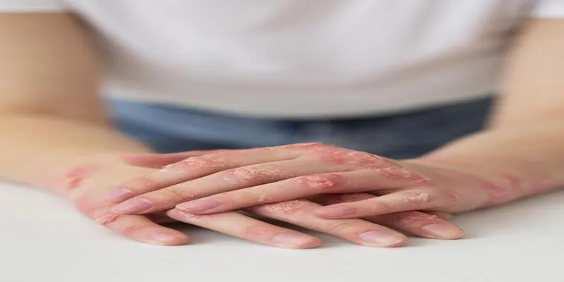 Xerotic Eczema Image