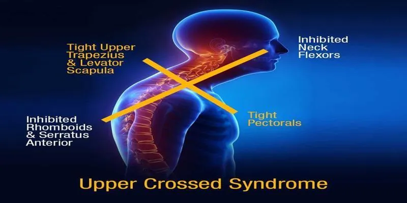 Upper Crossed Syndrome