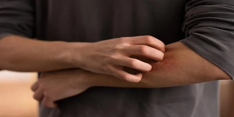 Causes of Xerotic
Eczema