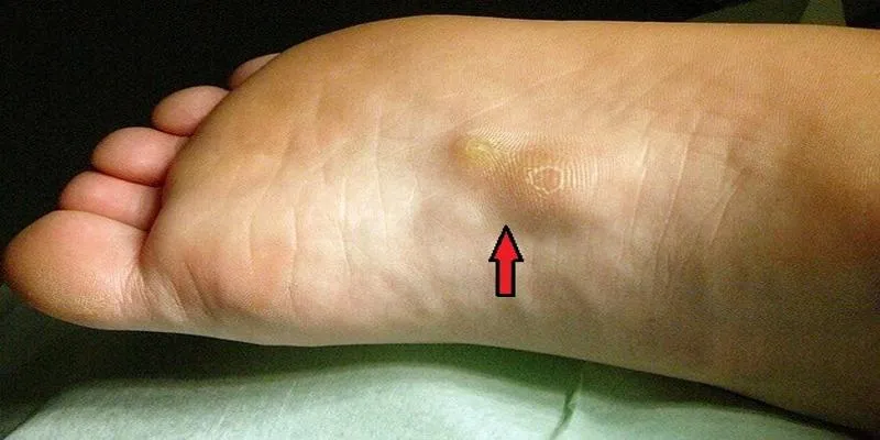 Plantar fibroma
illustration