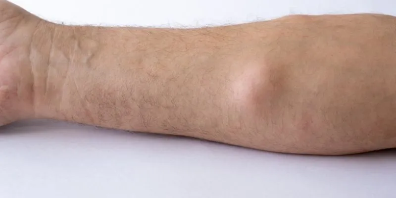 Lipoma under the skin