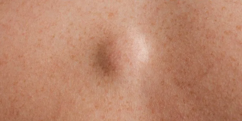 Lipoma diagnosis