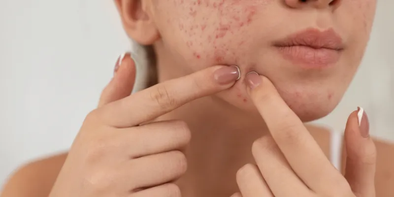 Acne Prevention Tips