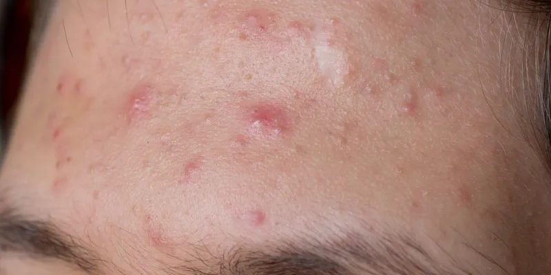 Types of Acne