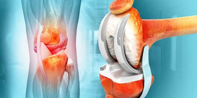 Osteoarthritis symptoms