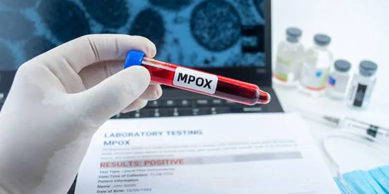 Initial symptoms of
monkeypox